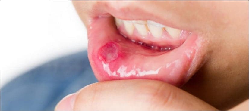 What are mouth ulcers and how you can get rid of them?