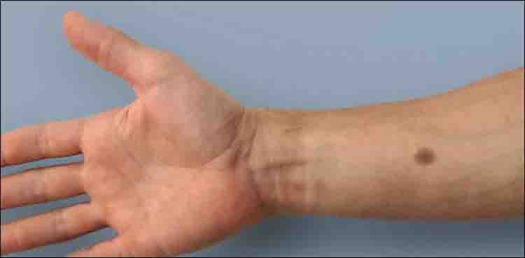 'Artificial mole' could warn of cancer: study