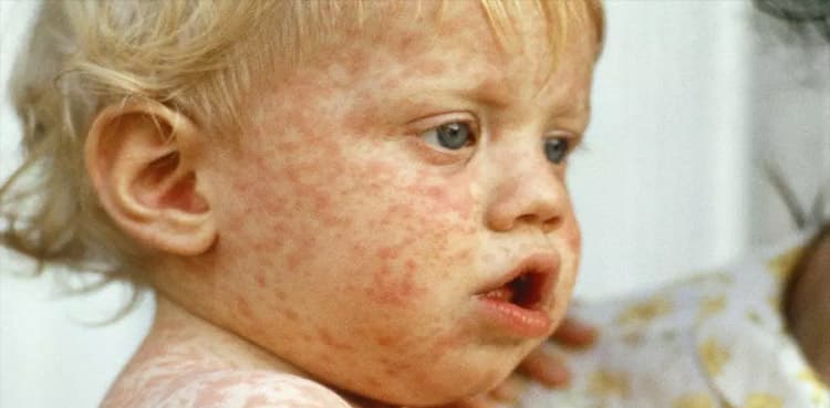 Factbox: What you need to know about the US measles outbreak