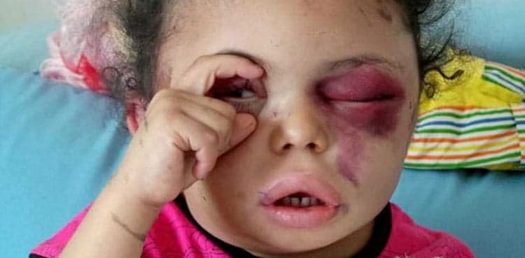 Young girl's tragic story makes her symbol of Yemen war