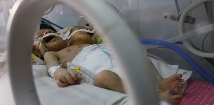 Yemeni conjoined twins die without treatment abroad