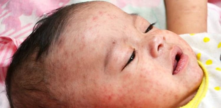 Fight vaccine hesitancy as 'contagious disease', UN meeting told