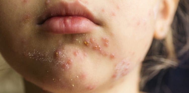 Number of US measles cases rises to 704 in 2019: official