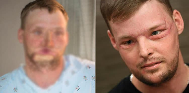 Most face transplant patients continue to report better quality of life