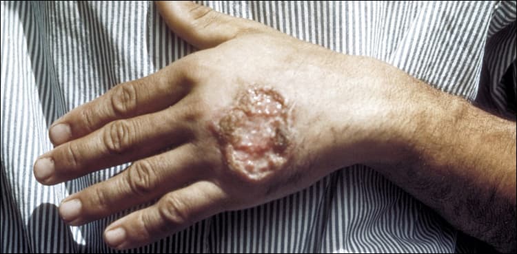 WHO provides Leishmania disease medicine to Pakistan