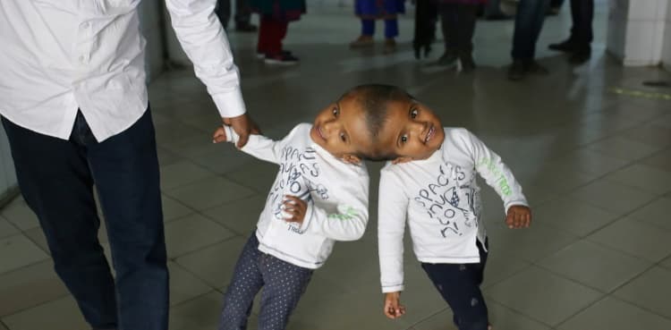 Doctors separate Bangladeshi twins joined at head