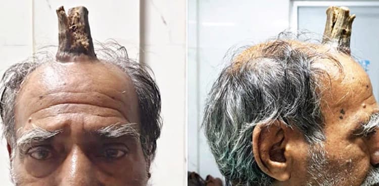 Doctors remove four-inch 'devil horn' from villager's head