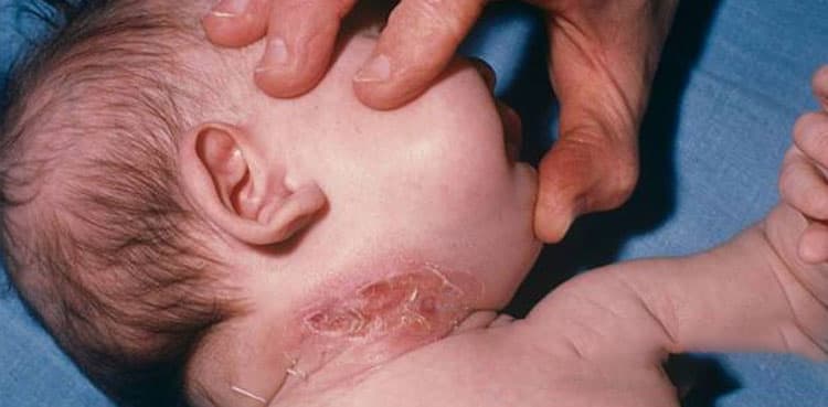 Diphtheria claims lives of 15 children in Badin coastal areas