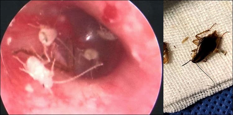 A whole family of cockroaches lived inside this man's ear?