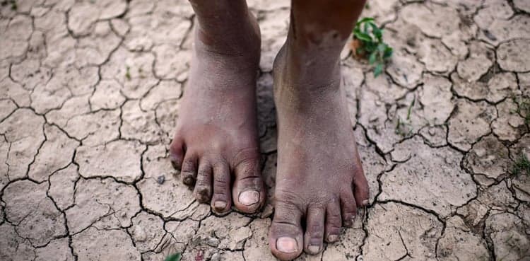 Thousands more underfed children may die due to COVID-19