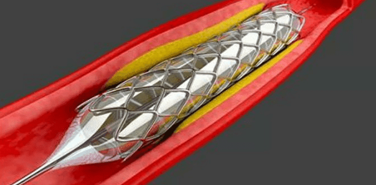 Punjab govt files reply in expired stents case