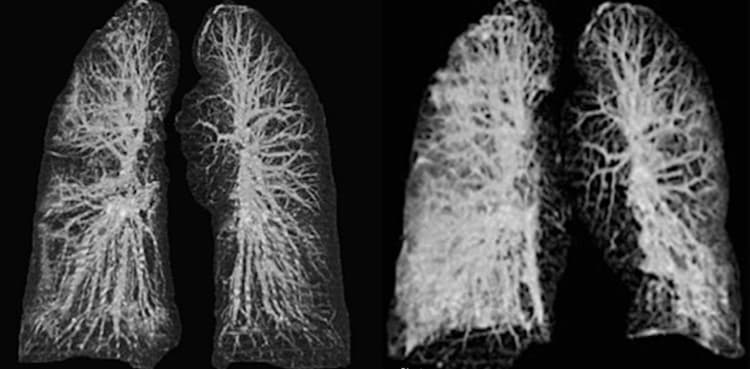 Shocking images reveal how coronavirus damaged two victims' lungs