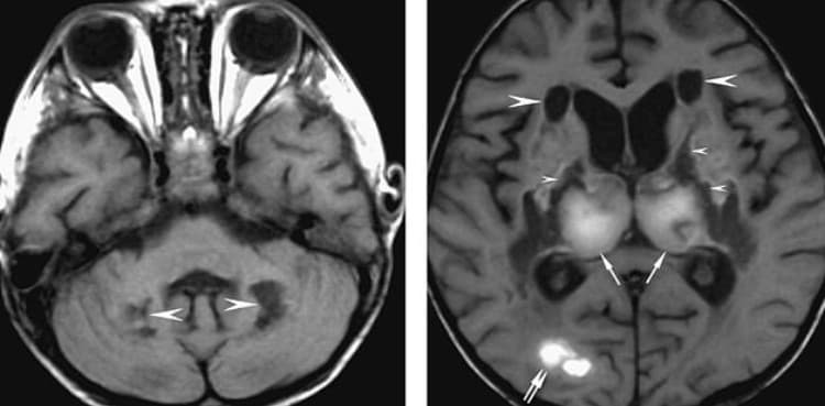 Coronavirus could cause permanent brain damage
