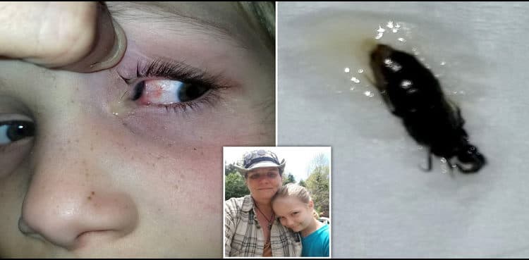 Bug squeezed out of minor girl’s eyes after crawling inside for nine hours