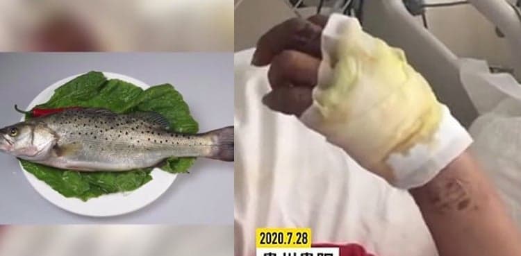 Man suffers from flesh-eating baterial infection after fishbone peirced his fingers