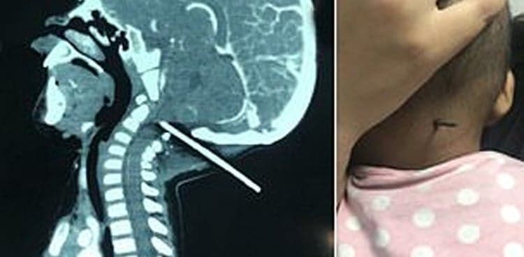 Toddler survives after steel rod rammed into back of his head