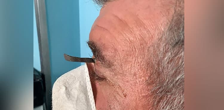 Inch-long nail pierces man's eyebrow in gardening accident