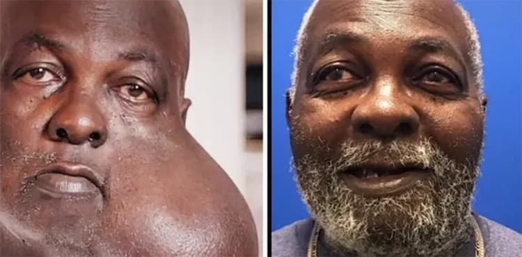 Doctor praised on TikTok for removing watermelon-sized tumor free of cost