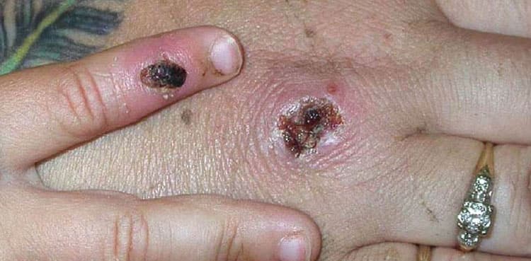 Rare virus: UK citizens vaccinated to stop spread of Monkeypox cases