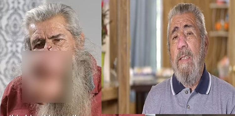 Dr. Pimple Popper removes two growths from man’s nose to ease his breathing problem