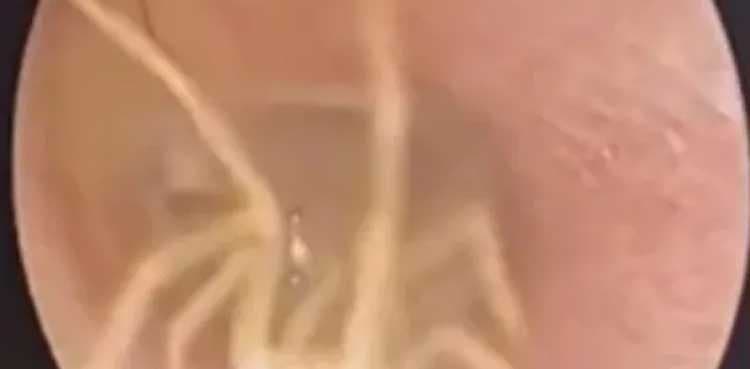 Doctor shocked after discovering spider in female patient's ear