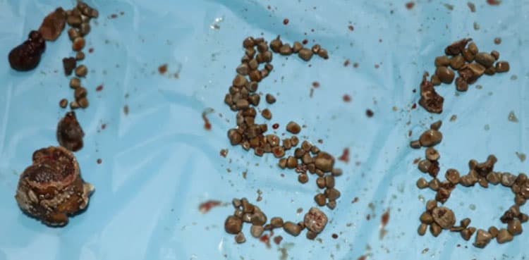 Record 156 kidney stones removed from single patient