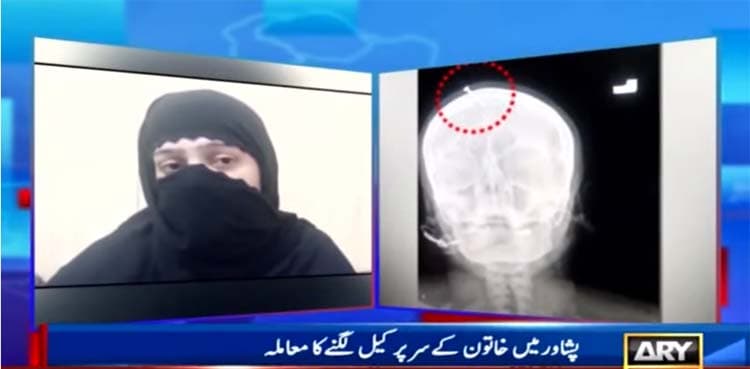 Hammered nail: Pregnant woman retracts remarks, blames doctor 