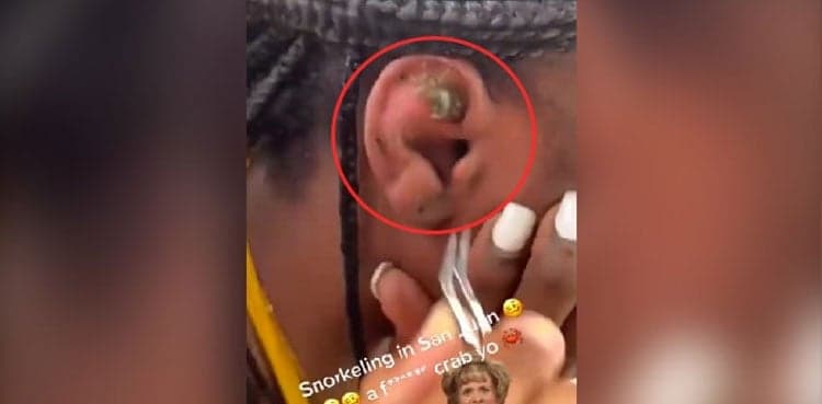 Horrific: Crab gets inside a woman's ear while snorkling
