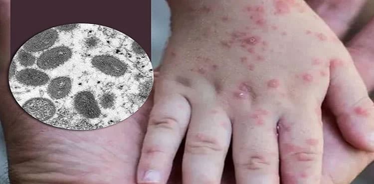 WHO to reconvene monkeypox emergency committee