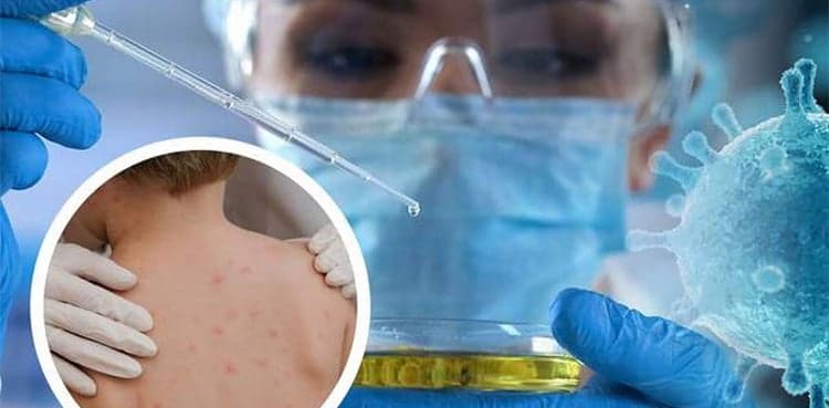 WHO says monkeypox 'containable'