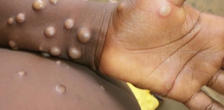 Monkeypox alert issued in Pakistan after cases detected in Europe, US