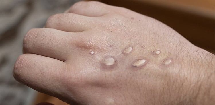 Sindh orders establishing Monkey Pox response units after deaths in Khairpur