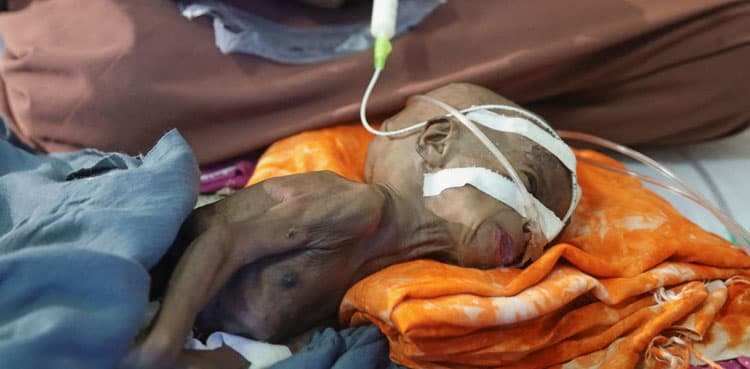 Child malnutrition soars in Somalia area on verge of famine