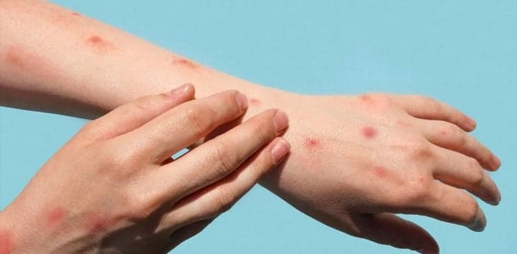 Monkeypox rocks Karachi as tenth case reported