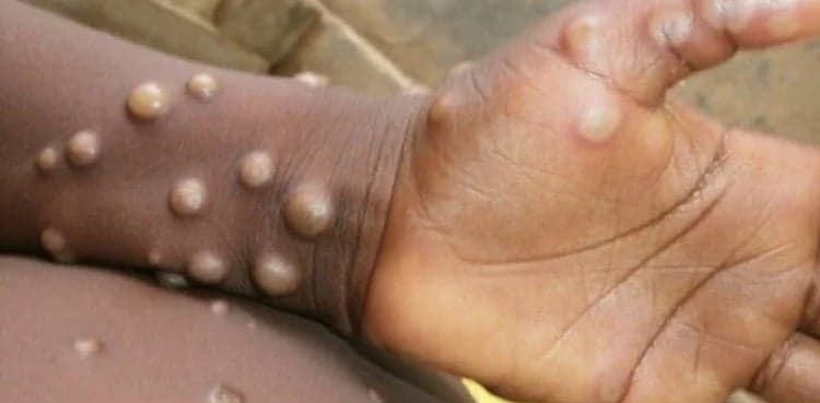 Monkeypox deaths: Islamabad doctors' team visits Khairpur