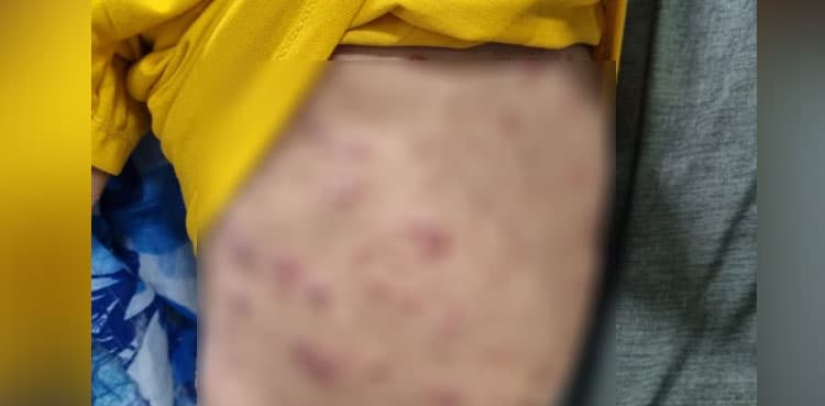 Karachi reports another suspected monkeypox case