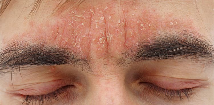 US approves drug to treat chronic skin disease