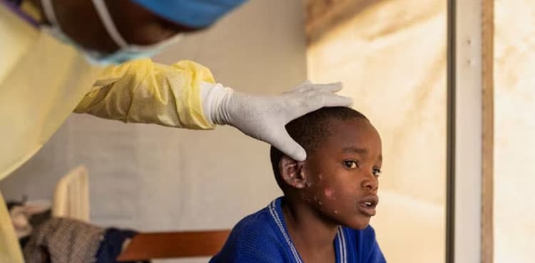Mpox is not the new COVID, says WHO official
