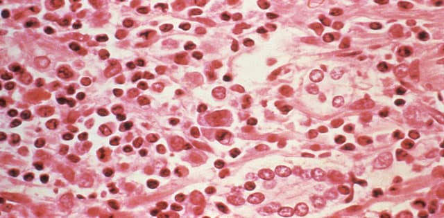 Evacuations planned as suspected hantavirus outbreak traps 150 on ship off Cape Verde