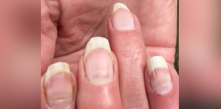 What are Covid nails and do you have them?