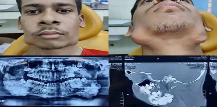Teenager suffering rare tumor gets 82 teeth removed in surgery