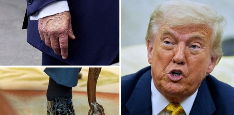 Trump diagnosed with 'chronic venous insufficiency'