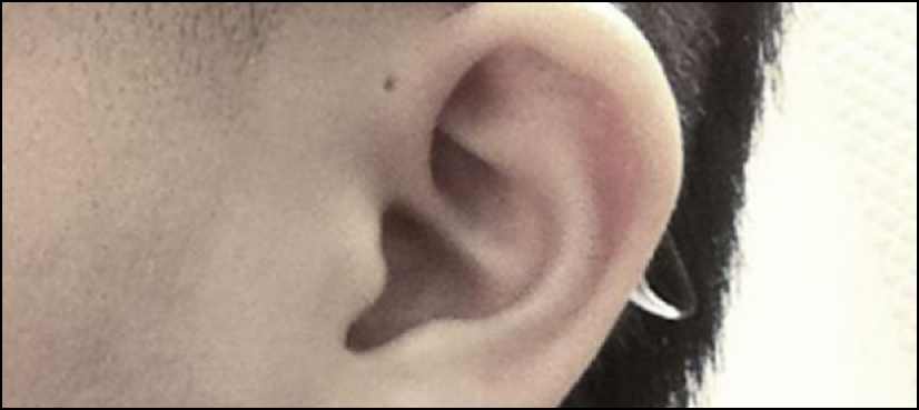 Some people are born with tiny holes above their ears – this is