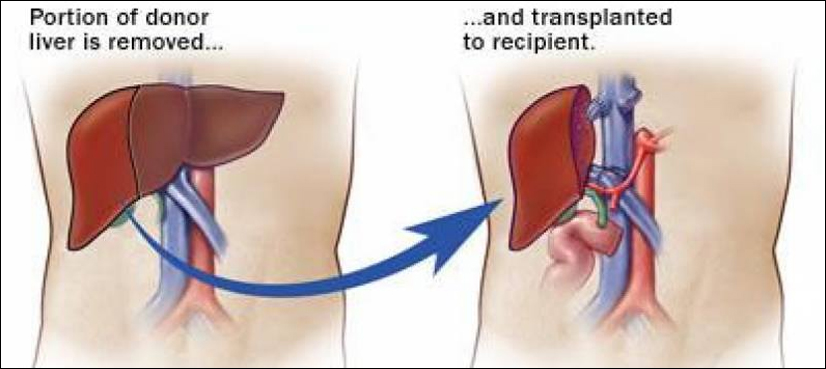 После пересадки печени. Ортотопическая трансплантация печени. Трансплантация части печени. Шрам после трансплантации печени. Рубец после трансплантации печени.