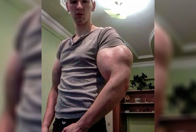 This Russian Bodybuilder With 24 Inch Biceps Could Lose His Arms 