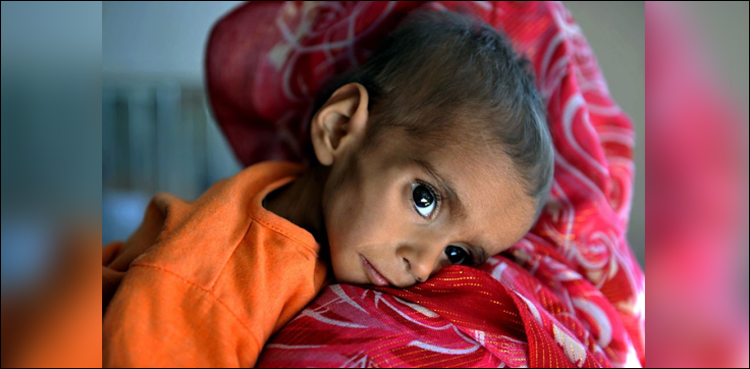 Tharparkar, Malnutrition