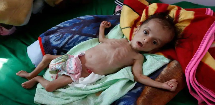 Yemen hospital struggles with number of malnourished children