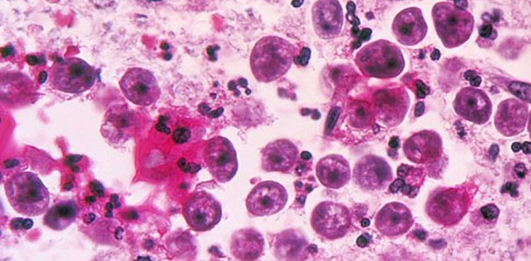 Naegleria Karachi claims life