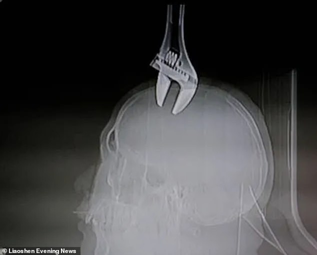 Man survives spanner struck head China