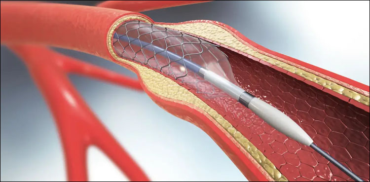 PIC, FIA, Fake stent case, Report